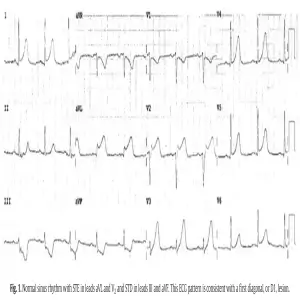 STEMI equiv 1 1st-Diagonal-Branch-of-LAD-Occlusion